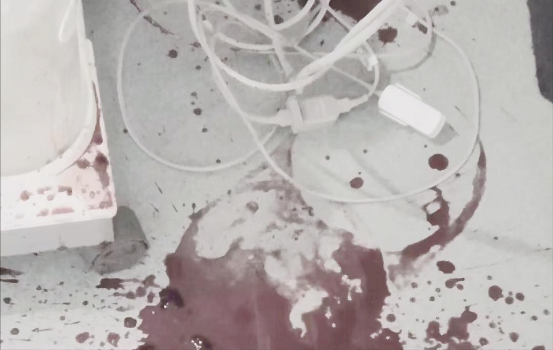 舌癌病例分享,舌癌吐血