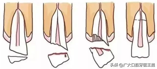 口腔科普缺牙而已真的这么可怕吗,口腔科普讲解牙齿缺失