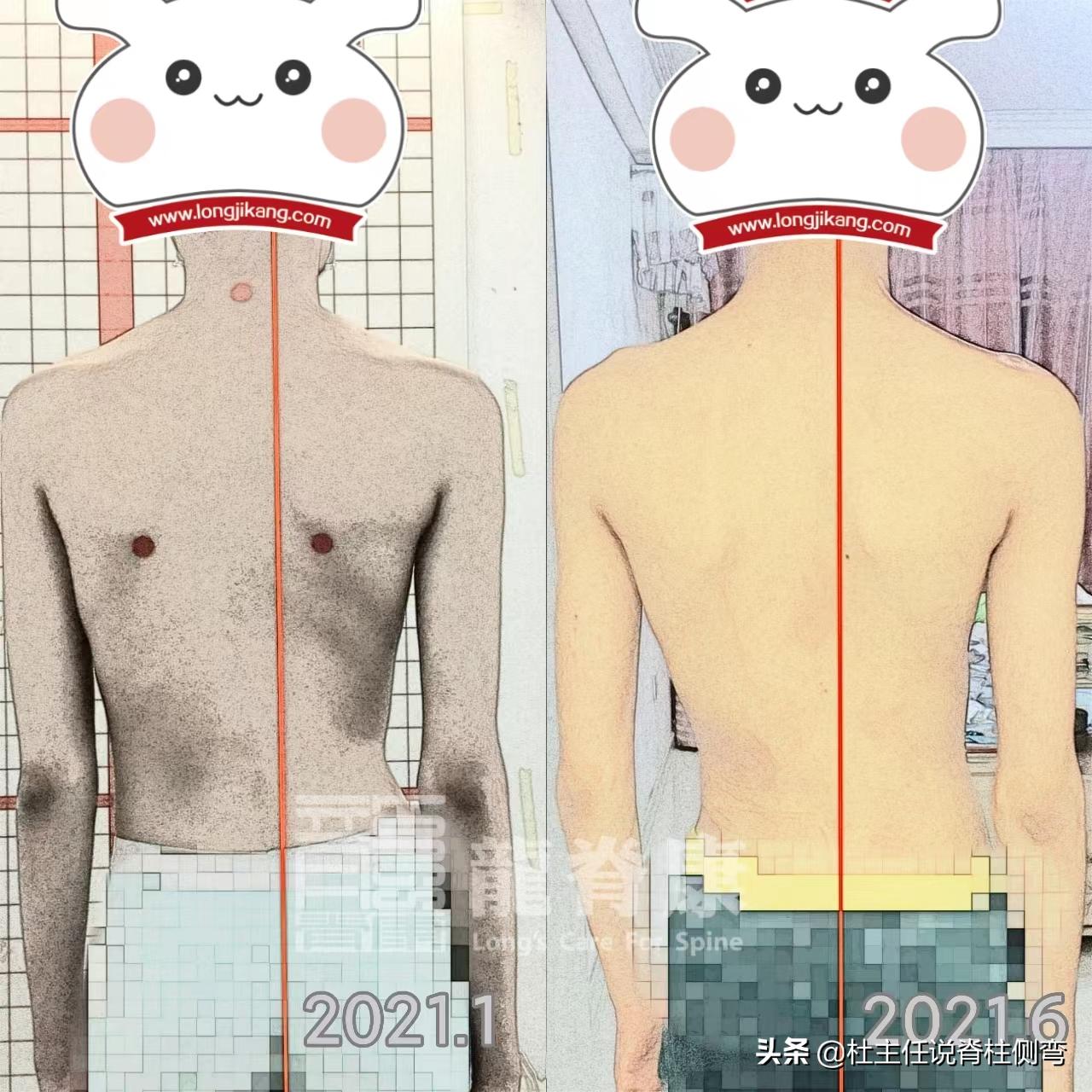 11至14岁青少年更易患脊柱侧弯,脊柱侧弯多少度会出现剃刀背