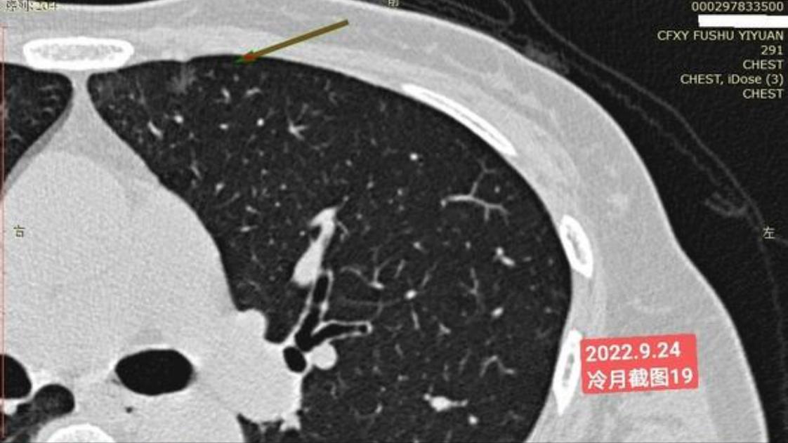 7mm肺结节恶性的怎么办,7mm实性肺结节危险程度