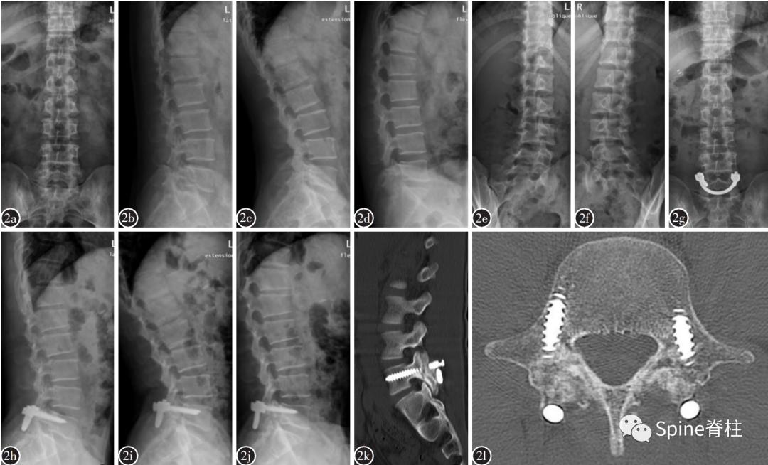 轻度峡部裂和重度峡部裂的区别,真性峡部裂和假性峡部裂