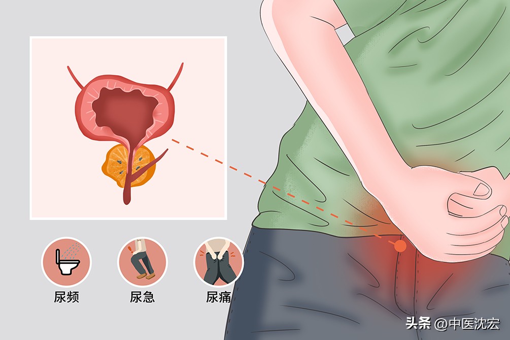 治疗前列腺炎尿频最佳的药,前列腺炎尿频尿急一招搞定