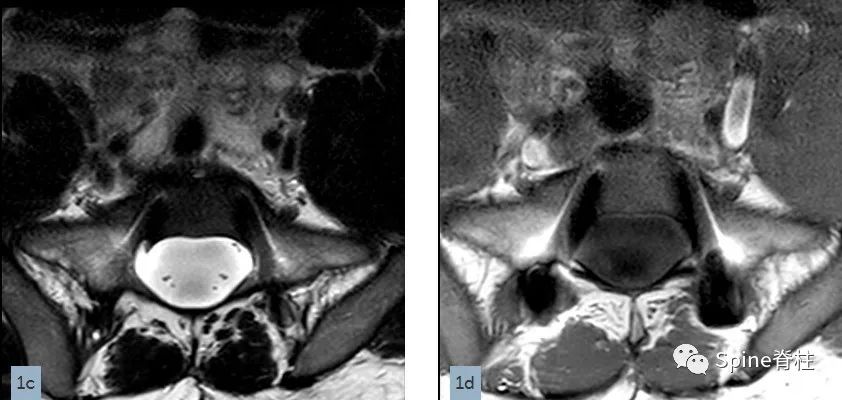 硬膜扩张,duralectasia