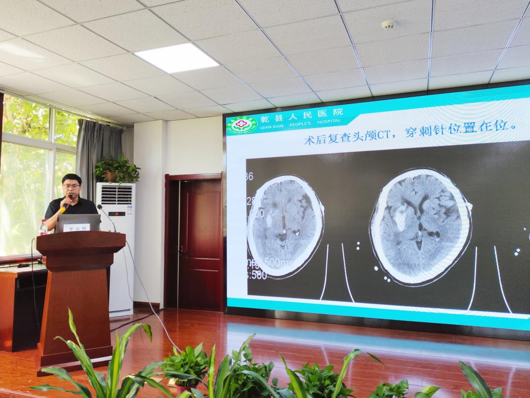 咸阳市第一人民医院脑出血微创,陕西治疗脑出血新技术