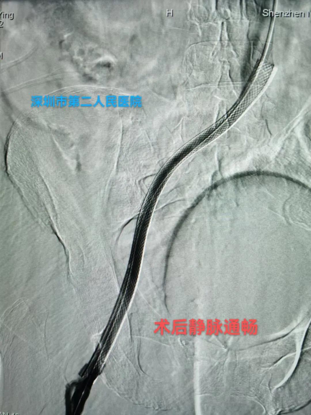 一到下午就腿肿什么原因怎么治疗,腿肿是什么病的前兆怎么治疗