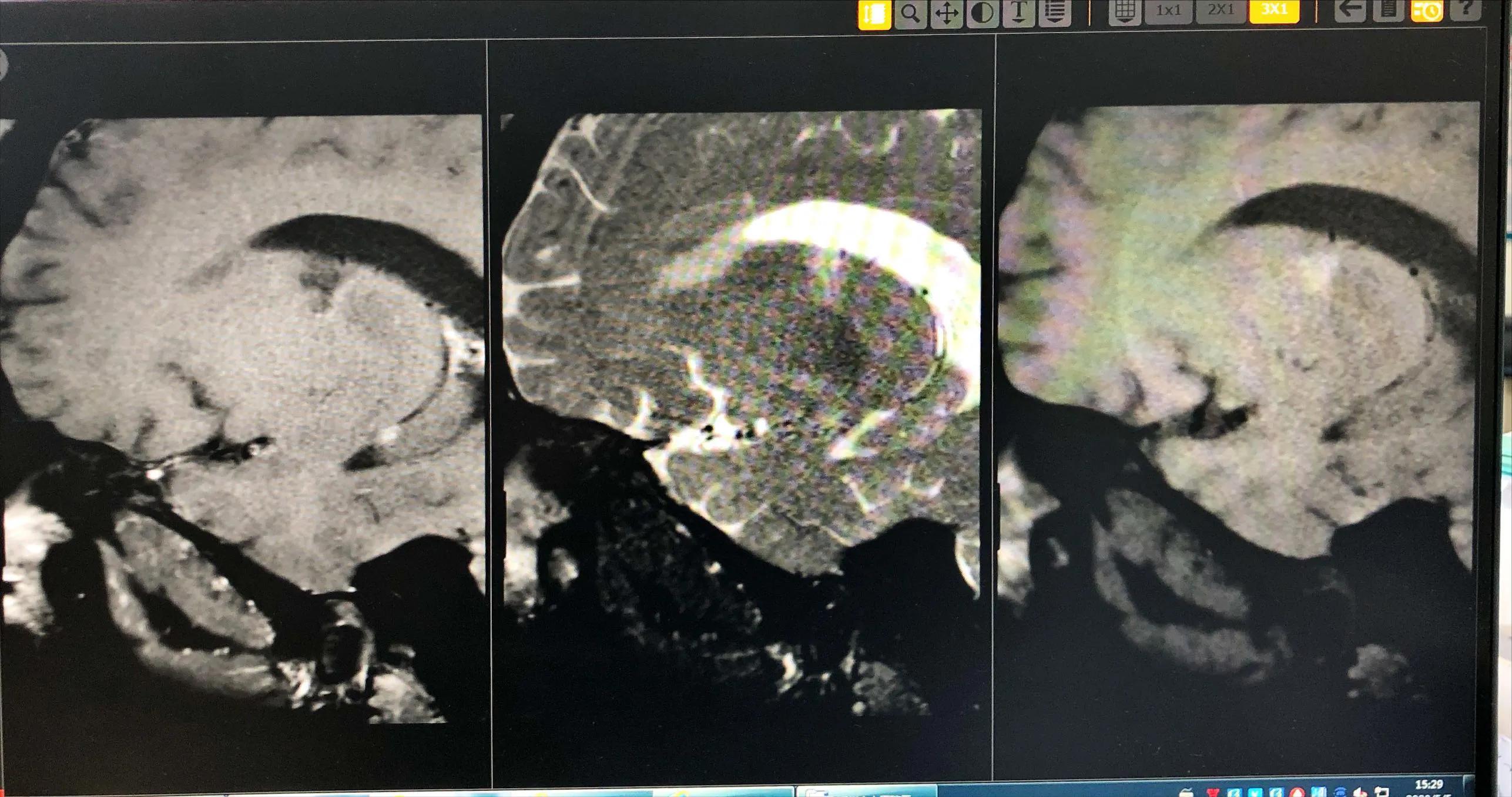 血管健康日为什么定在5月18日,血管的健康日
