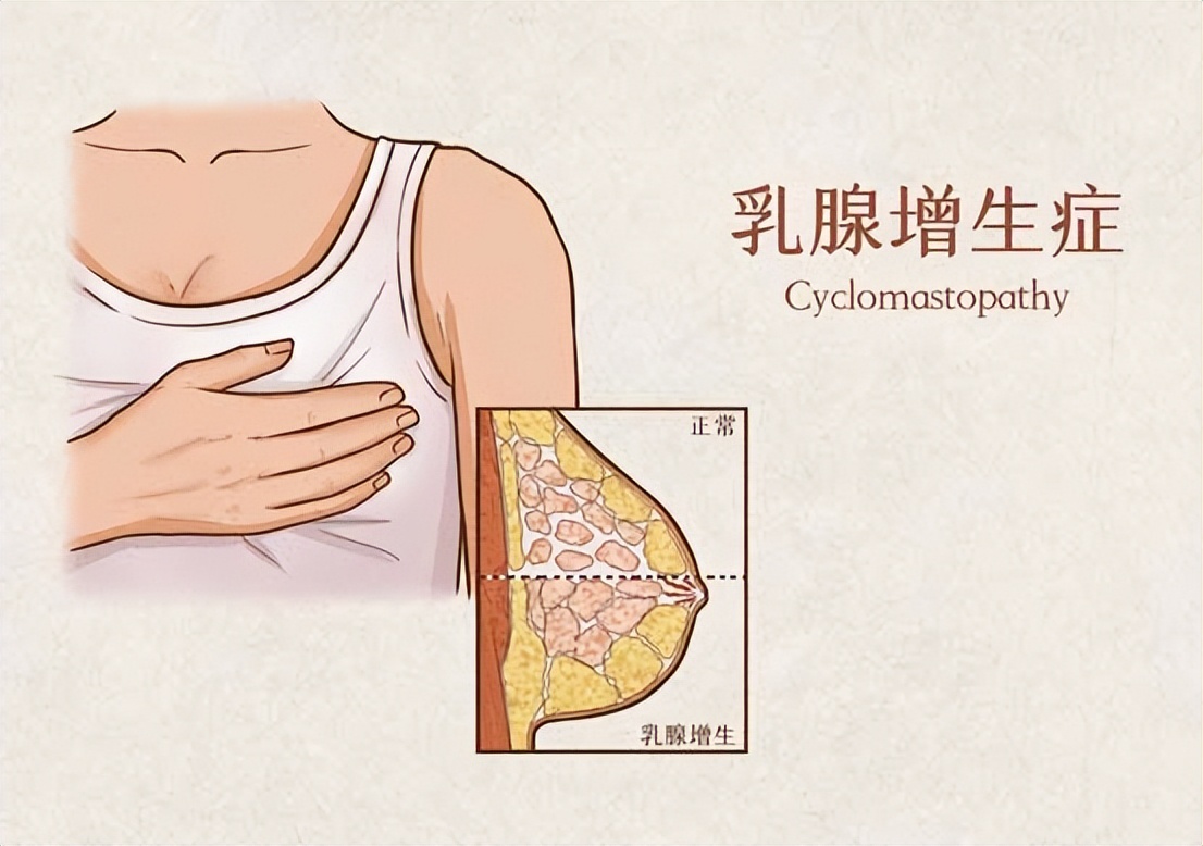 良性的乳腺肿块不动手术会癌变吗,乳腺结节良性三级严重吗会癌变吗