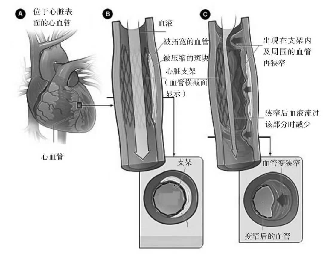 明明放了支架为什么还会堵塞,为什么做了心脏支架会胃大出血
