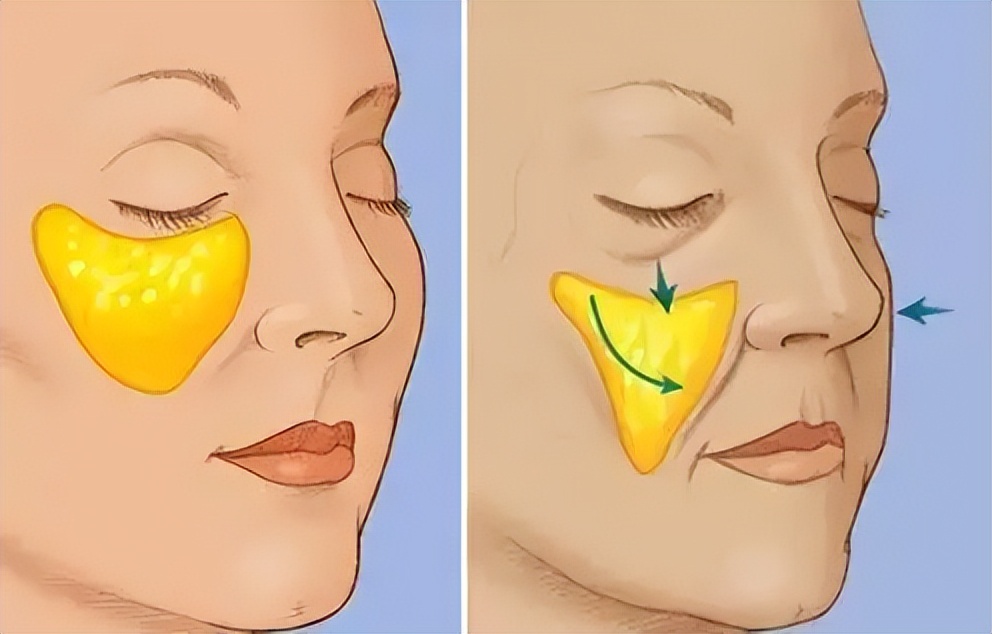 苹果肌塌陷不饱满怎么办,苹果肌干瘪怎么办