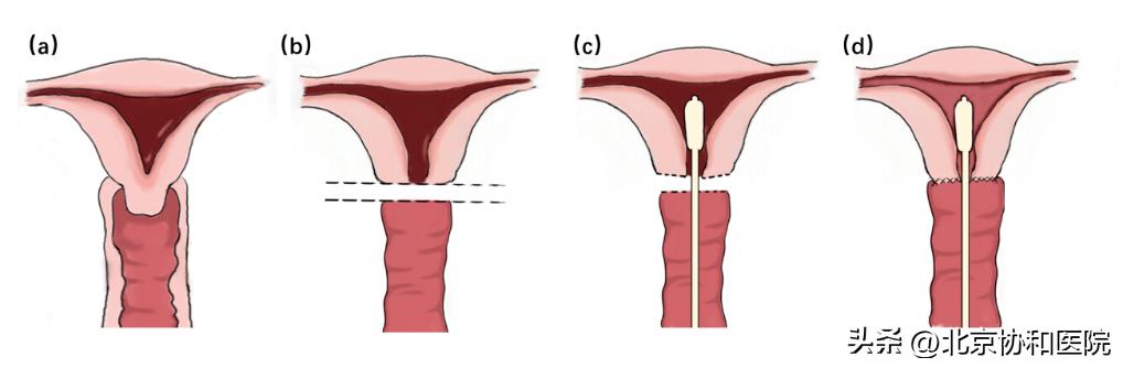 协和医院在ScienceBulletin发表先天性子宫颈发育不良诊断及手术治疗新观点