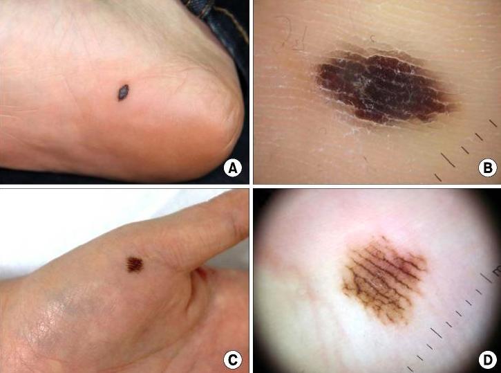 甲母痣癌变几率多大,多大的痣会癌变