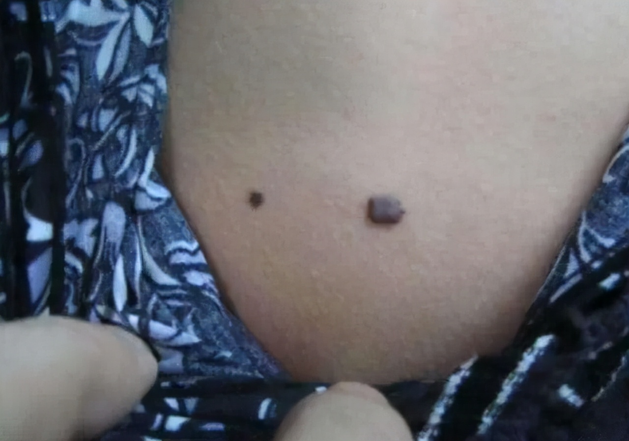 怎么在医院确定黑痣是不是良性的,黑痣隆起挂什么科检查