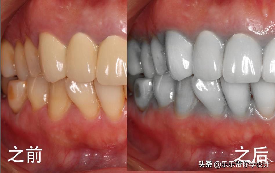 ps最真实美白牙齿教程,牙齿怎么用ps调美白