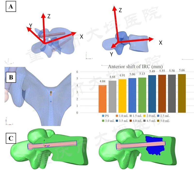 骨水泥螺钉治疗腰椎骨折,骨水泥钉技术