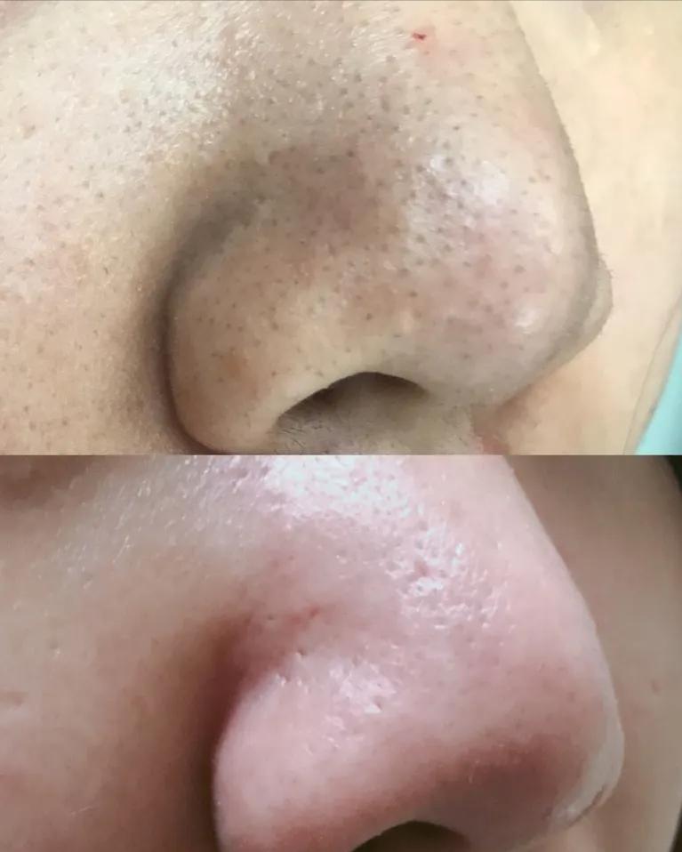 鼻子的黑头跟草莓一样,草莓黑头怎么去除最有效