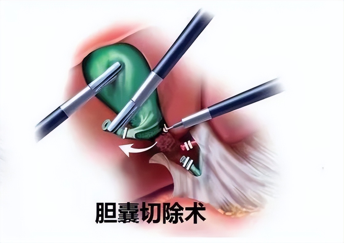 急性胆囊炎的主要治疗方法有哪些,急性胆囊炎最佳的治疗方案是什么