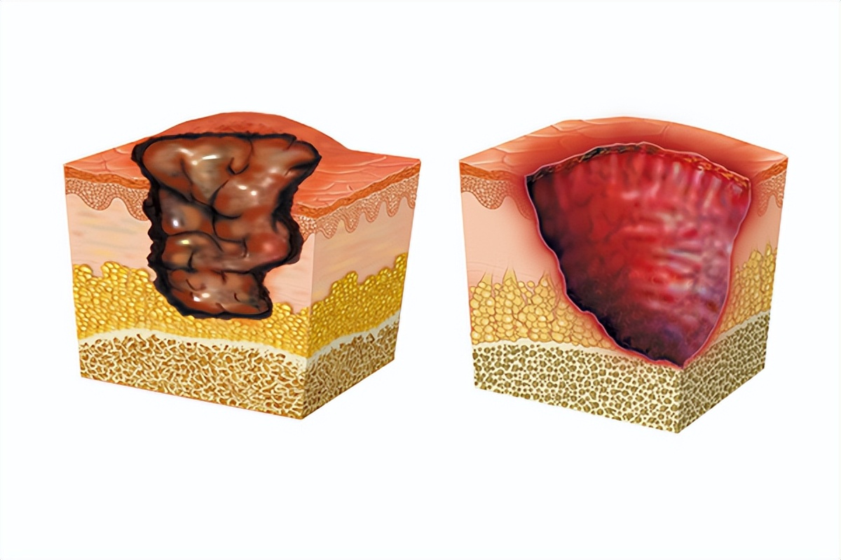 褥疮清创手术是什么？为什么要清创？