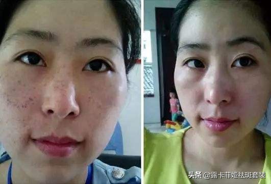 祛斑效果排名第一产品有哪些,哪个牌子的祛斑产品最有效果最好