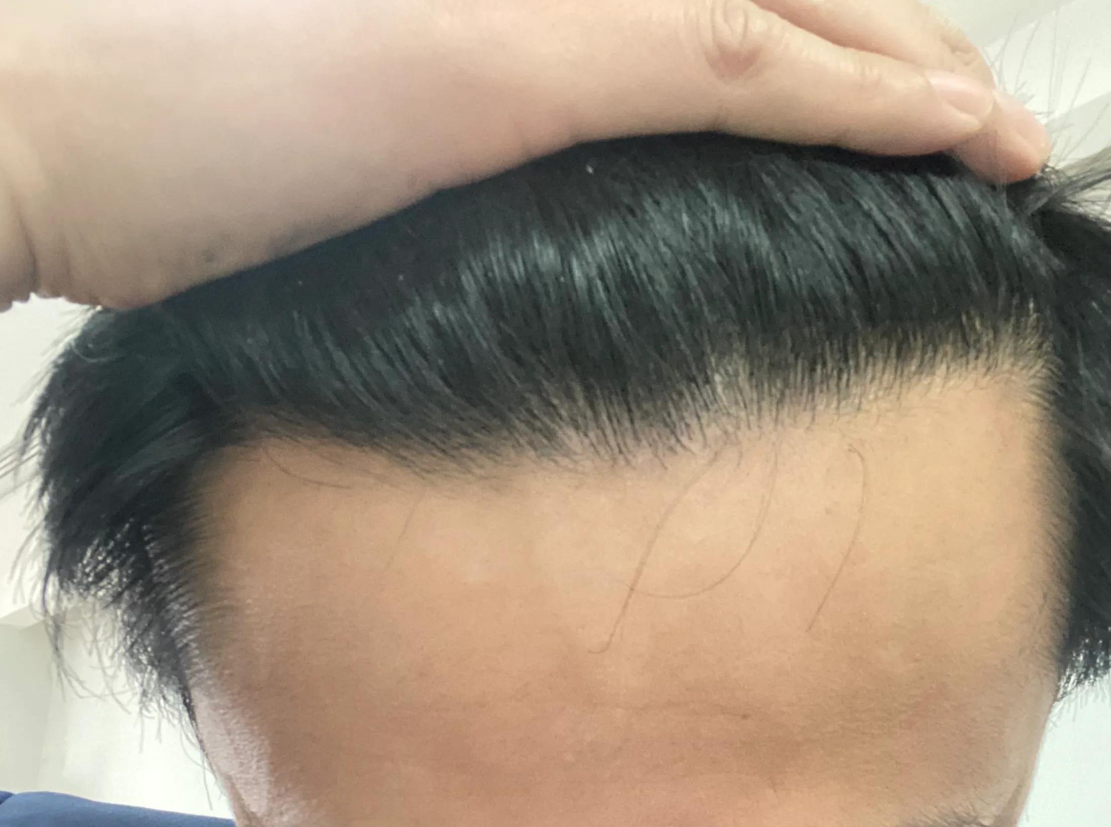 花费四万元植发一年后效果仍不明,男生大面积植发八个月真实效果