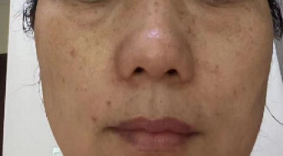 有什么方法可以真正祛斑,祛斑的有效方法红霉素软膏祛斑