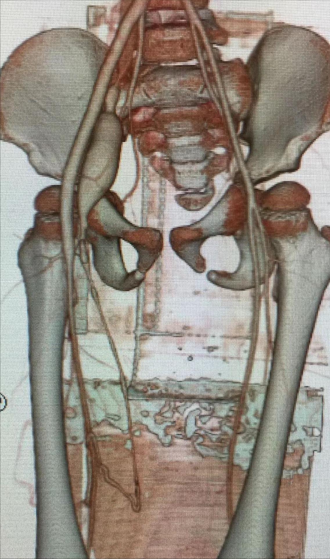 下肢静脉血管瘤,动静脉血管畸形微创介入