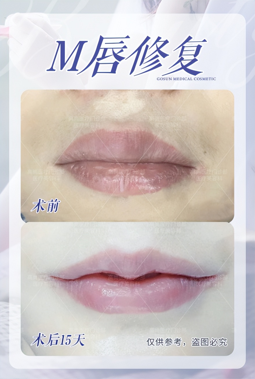 嘴唇厚其实有很多烦恼,嘴唇厚的女生有什么特点