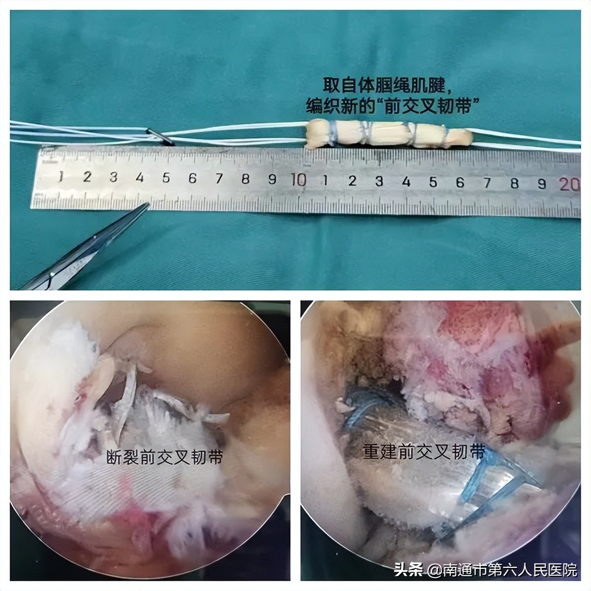 小伙打篮球前十字韧带完全断裂,小伙子打篮球双手断了