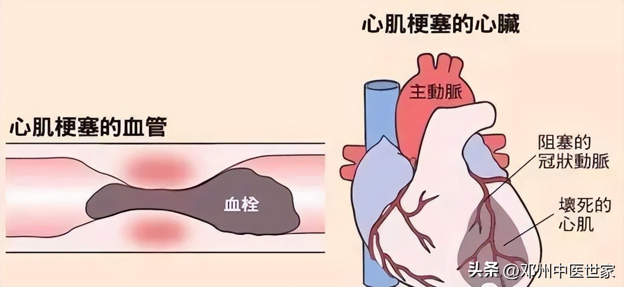 心梗打支架后的中医治疗,心梗消融术