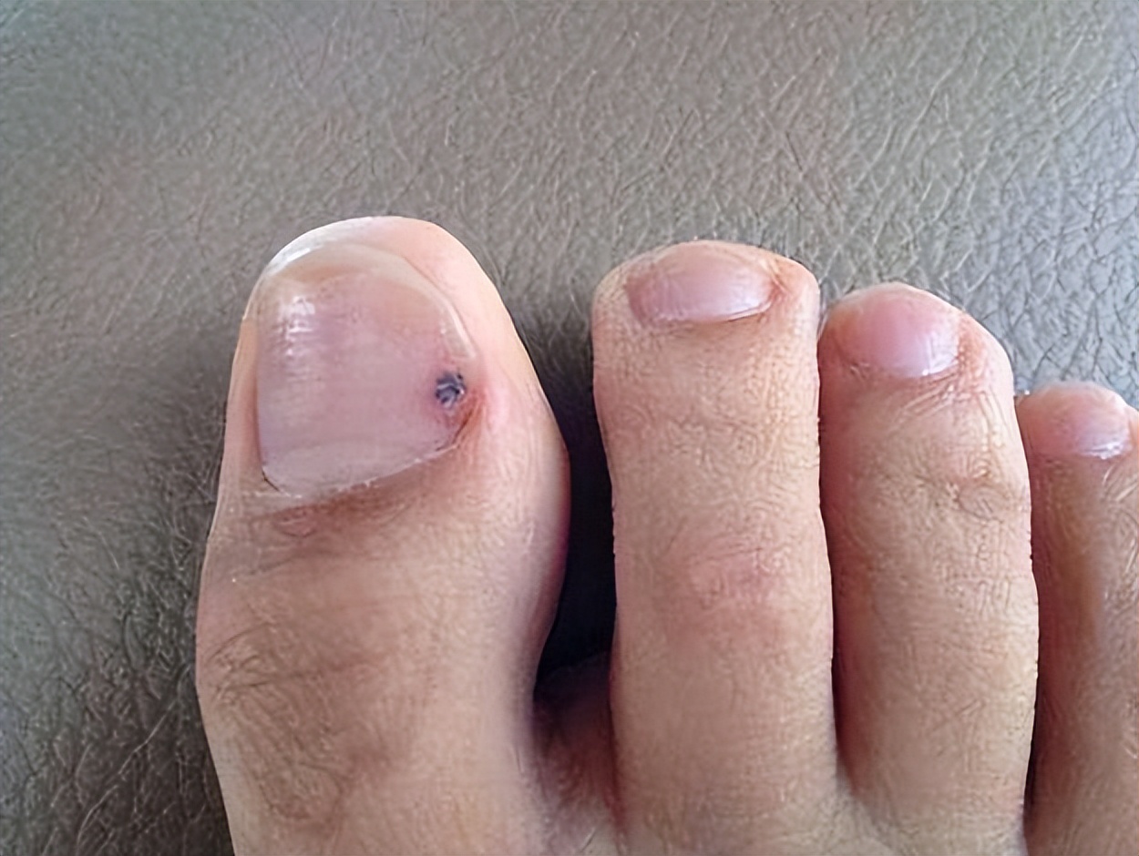 医生发现大黑痣的秘密,这些地方长黑痣要注意