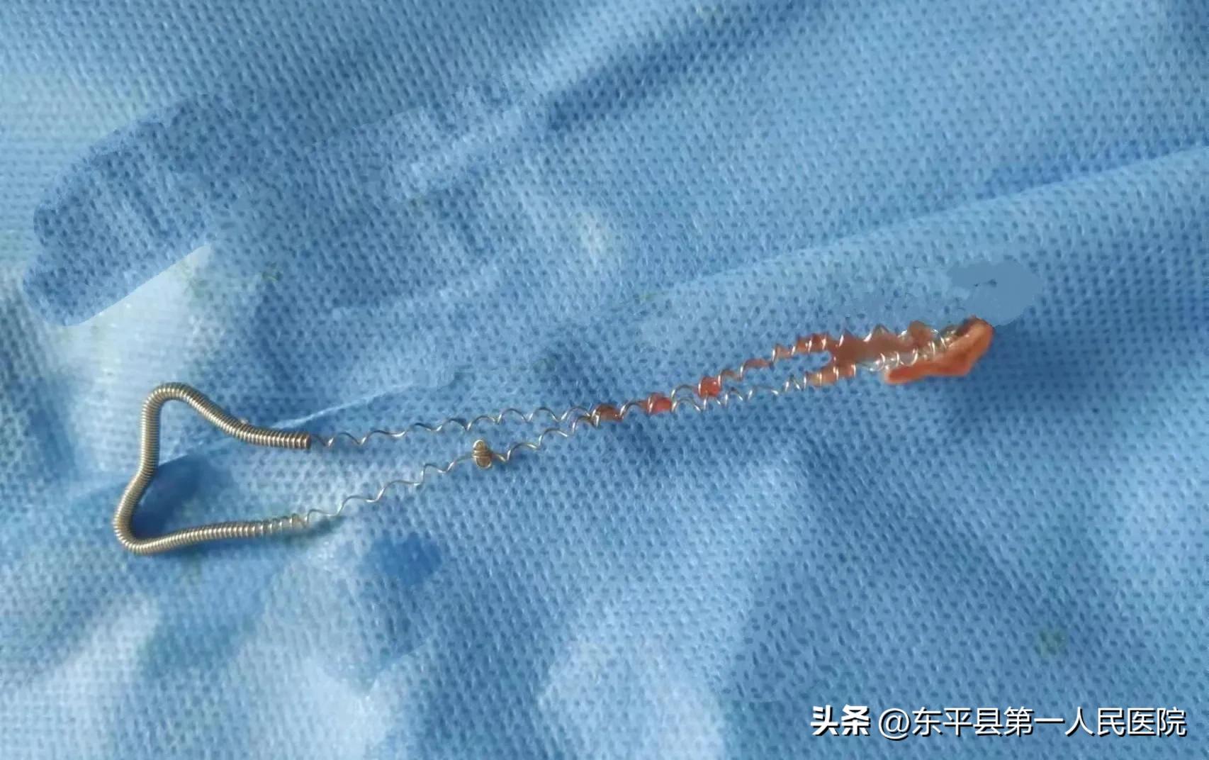 绝经后，你取环了吗？