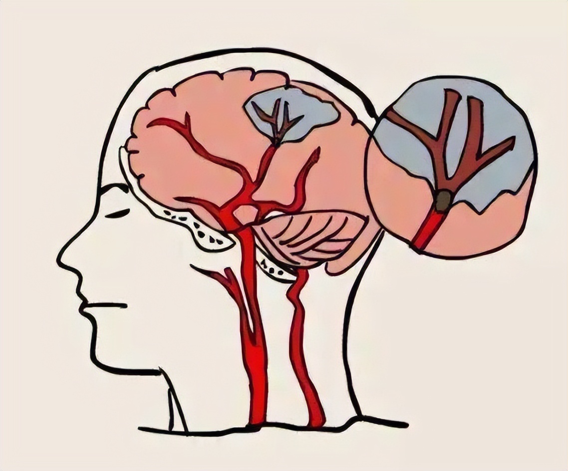 老人脑萎缩怎么办三种办法助恢复,老年人脑萎缩怎么改善