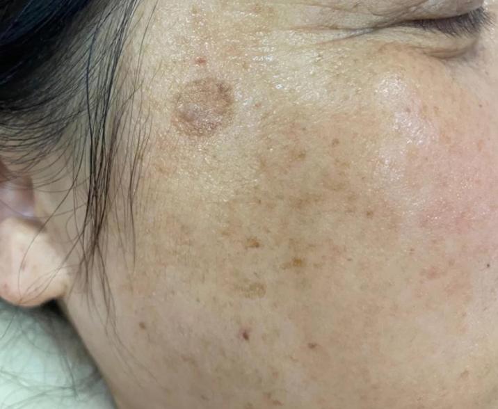 牙膏治疗老年斑小妙招,用生姜和牙膏祛老年斑哪个好