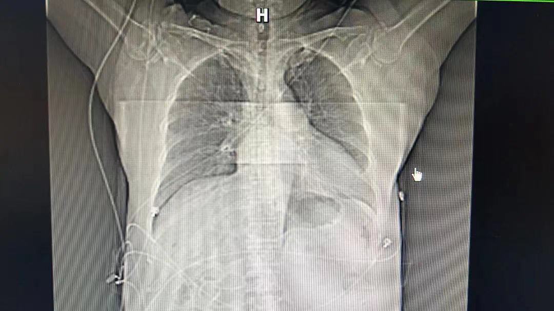 中国首例人工心脏植入手术,甘肃成功首例人工心脏植入手术