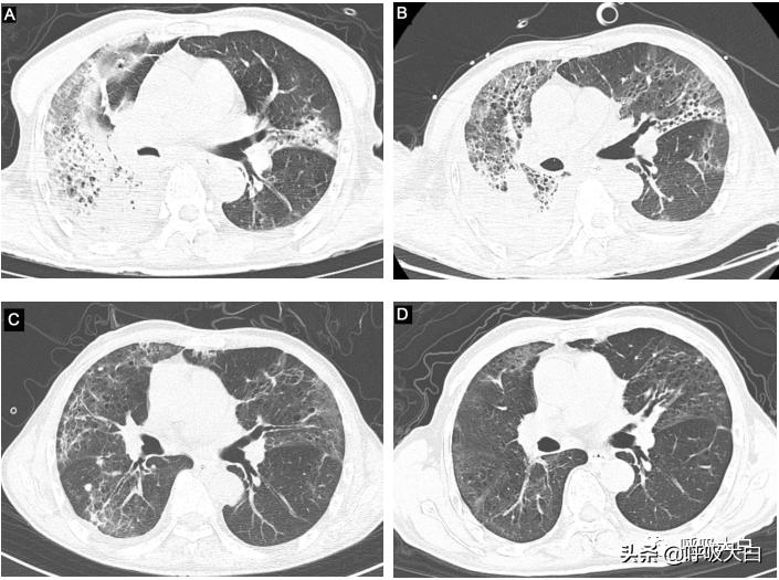 鹦鹉热病例分享,鹦鹉热怎么用药