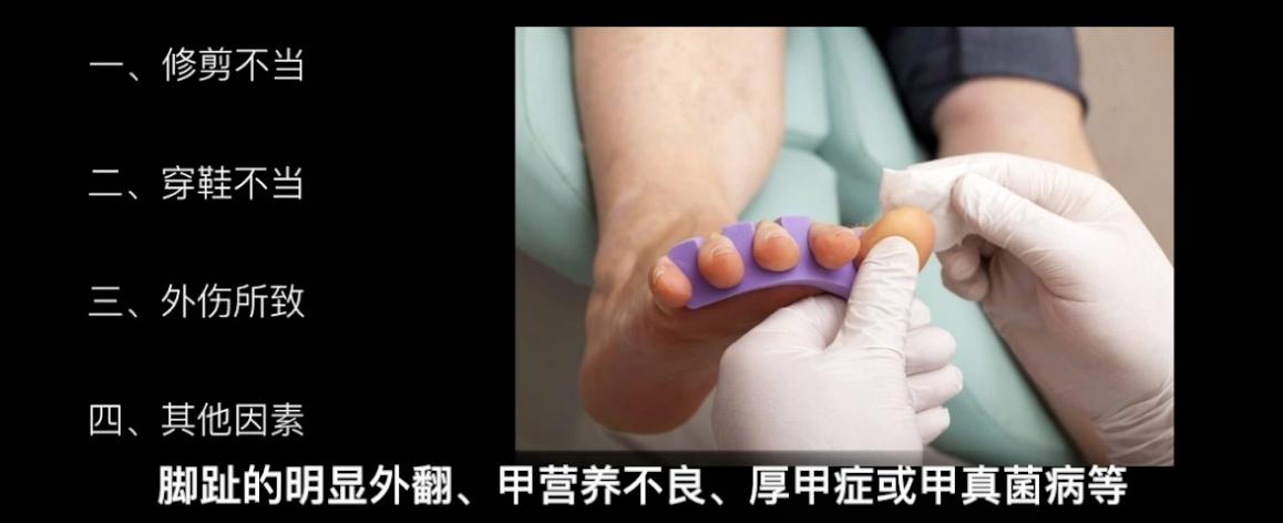 得了甲沟炎一定要拔指甲就能好吗,甲沟炎指甲陷肉里拔不出来怎么办