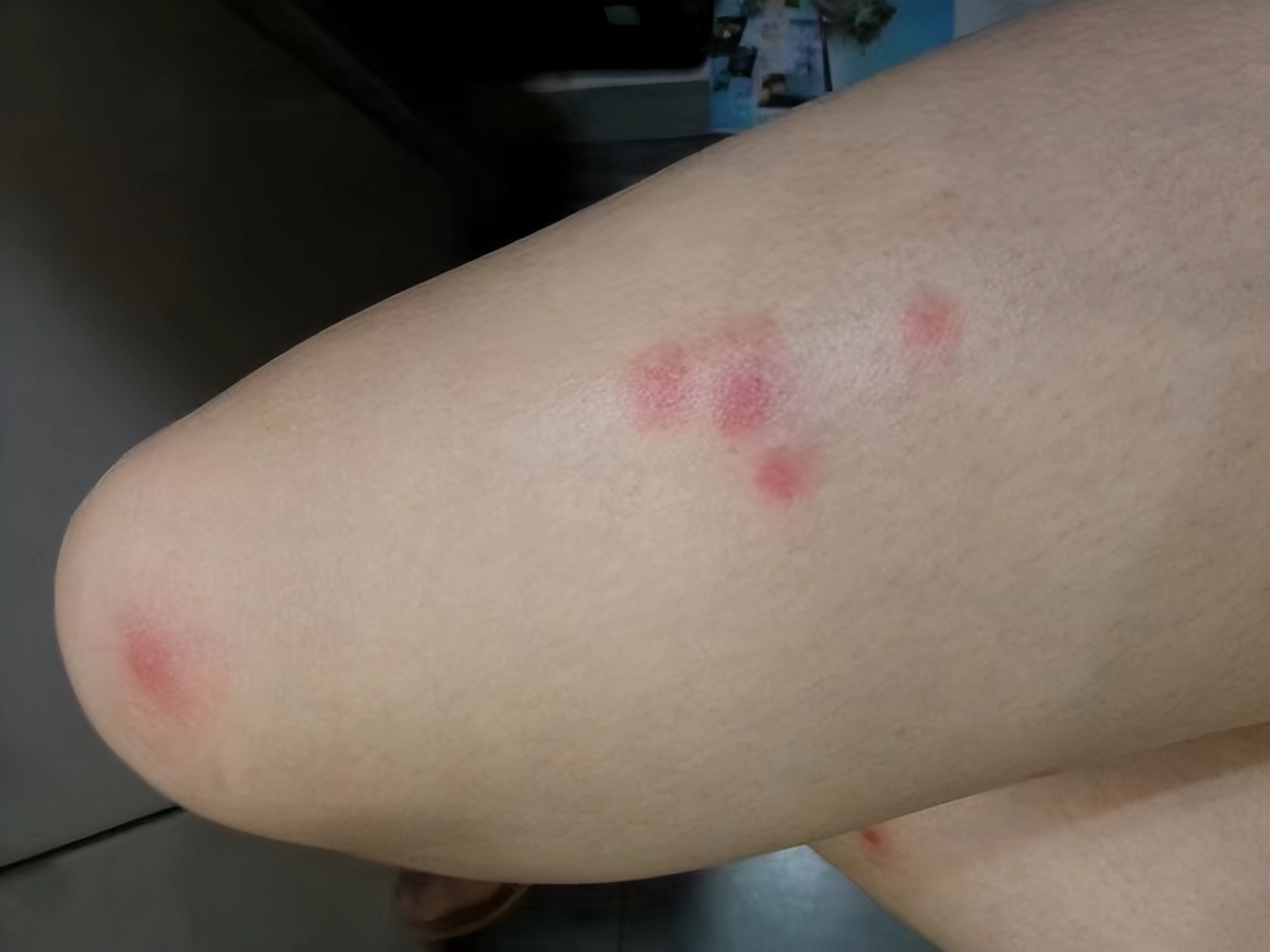 一到夏季胳膊关节内侧起红疹,一到夏天胳膊上起了好多小疙瘩