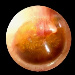 分泌性中耳炎可以吃耳聋通窍丸吗,儿童中耳炎鼓膜内陷耳鸣