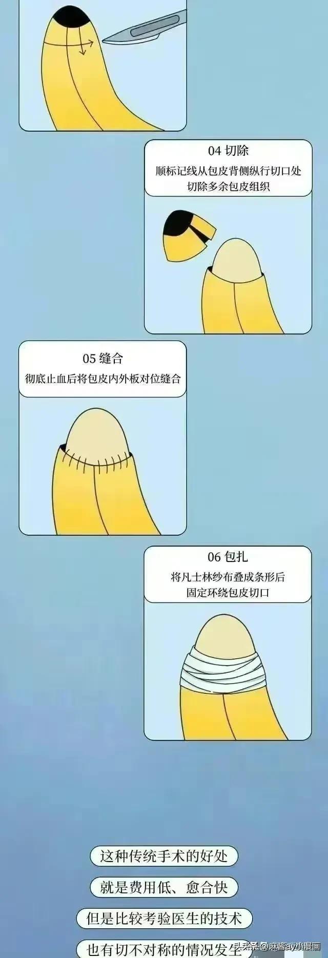 男生割完包皮,割完包皮后变化