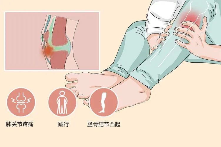 膝盖髌骨软骨疼痛部位对照表,膝盖下方胫骨疼痛部位对照表