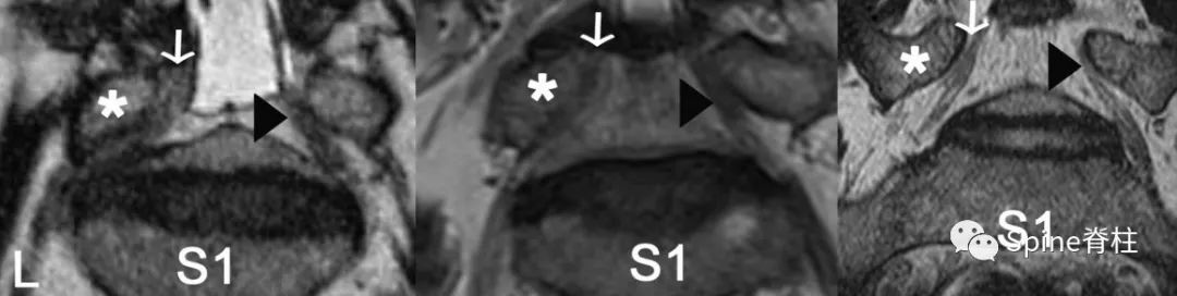 腰椎间盘突出下肢放射痛严重吗,下肢放射疼痛是间断性严重吗