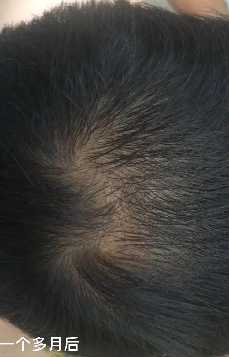 脱发的人日常注意4点,脱发的今日心得100字