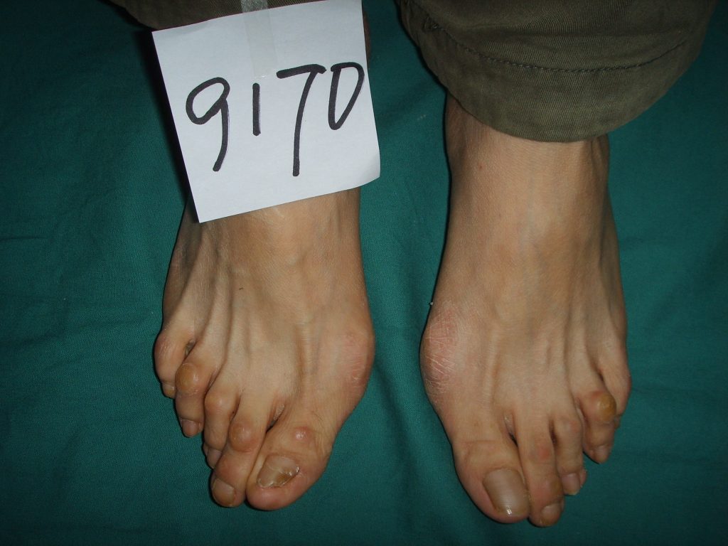 拇外翻是怎么形成的有什么危害,拇外翻的原因及处理方法