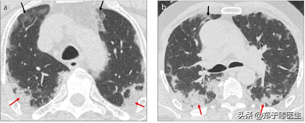 新冠病毒是如何损坏肺功能的,新冠病毒引起的肺部炎症怎么办