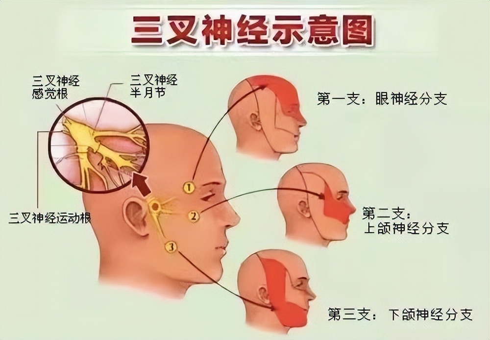 怎样治三叉神经痛牙疼,三叉神经痛包括牙痛喉咙痛耳朵痛