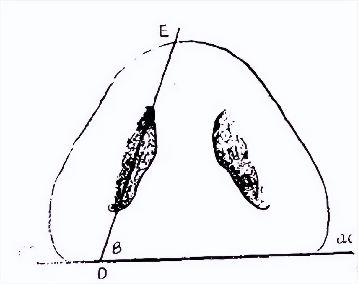 隆鼻以后鼻孔外露算是失败吗,露鼻孔的鼻子怎么隆鼻