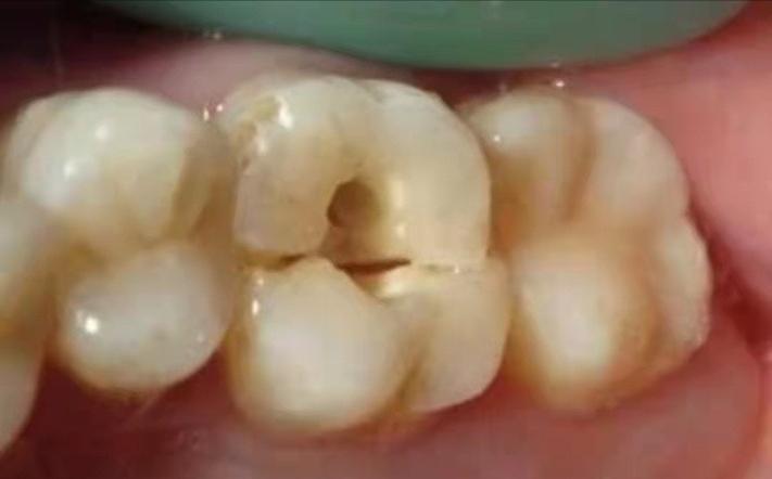 根管治疗后牙齿一直不舒服,根管治疗后牙齿需要全冠吗