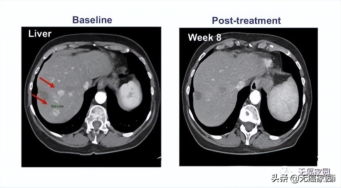 肝癌的防治干预计划,肝癌患者免疫治疗需长期治疗吗