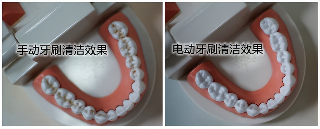 电动牙刷的危害弊端,使用超声波电动牙刷有什么危害吗