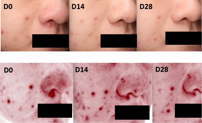 祛痘面膜成分测评,自制面膜祛痘效果最好的方法