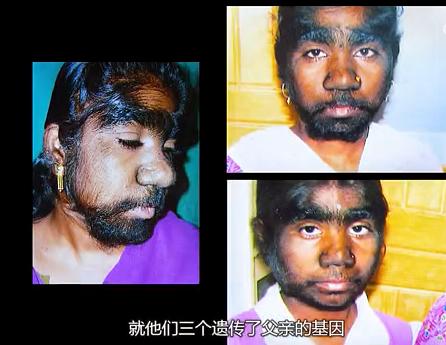 故事:非洲17岁女孩长满络腮胡,毛发从鼻孔长到脖子,身体有何异常